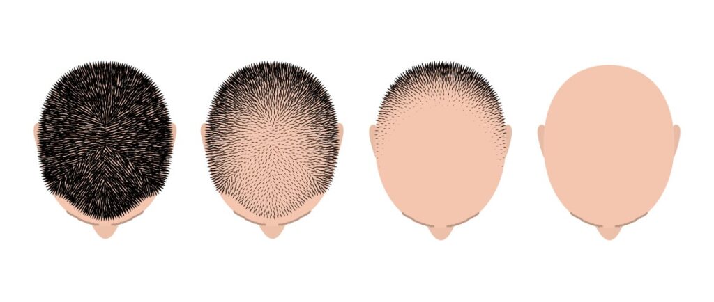 HAIR TRANSPLANTATION