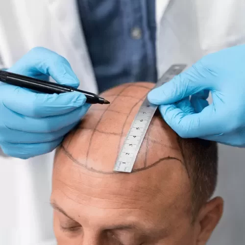 HAIR TRANSPLANTATION