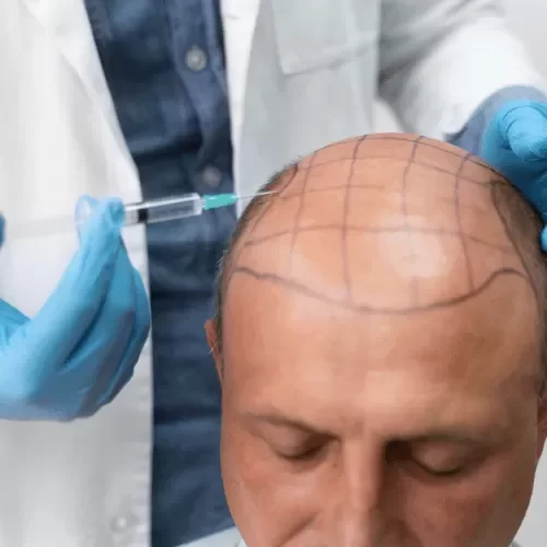 HAIR TRANSPLANTATION