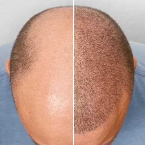 HAIR TRANSPLANTATION