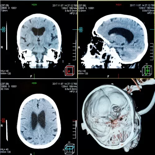 Neurosurgery vasco