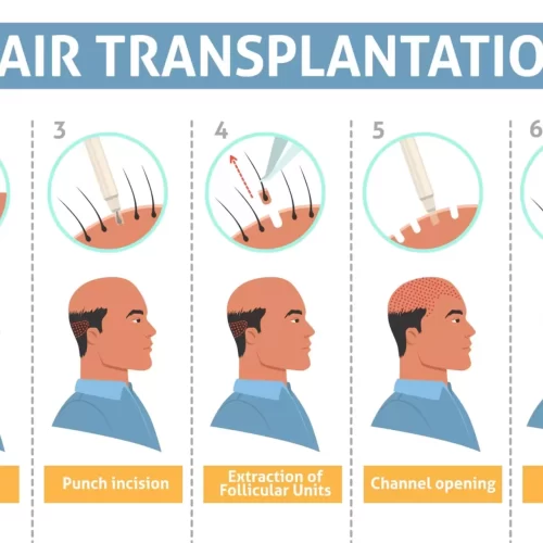 HAIR TRANSPLANTATION